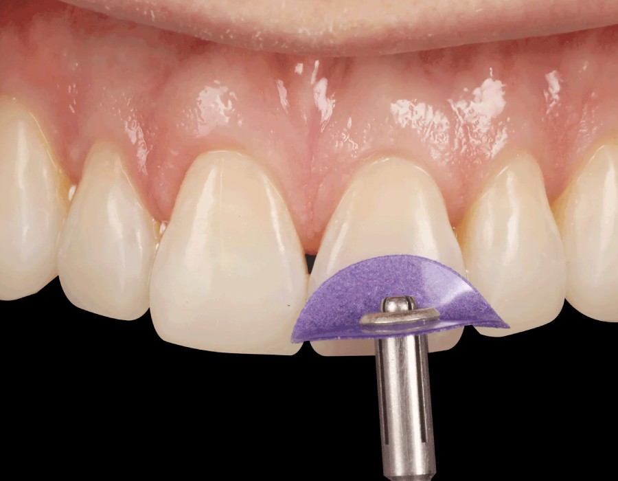  Anterior Restoratif Tedaviler-4